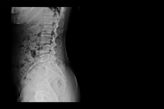 x-ray image of a woman (right side)  show  L-S spine AP and Lateral and blank area at right side.  Spinal Stenosis or vertebral stenosis or Lumbar Degenerative Spinal Canal Stenosis.
