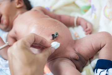 Infant baby boy navel clean by cotton swap treatment