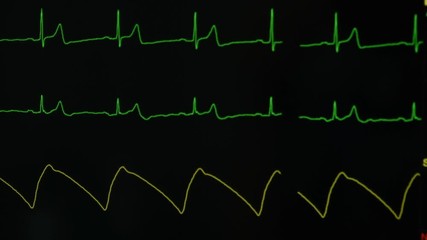 Computer screen display patient vital signs in intensive care unit
