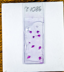 Slices of the tumor under glass. Histological examination of tumor cells for the presence of cancer