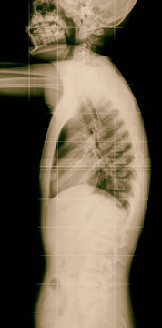 X-ray lumbo-sacral spine and head