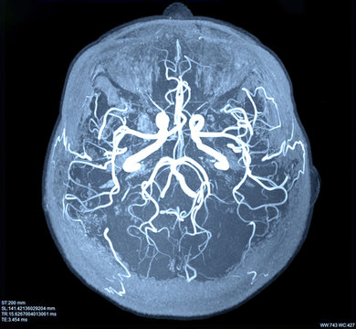 MRI of the blood vessels