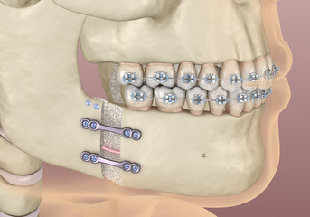 Mandibular Advancement surgery. Medically accurate dental 3D illustration.