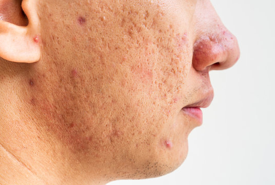 Close up of problematic skin with deep acne scars on cheek men pigmentation.