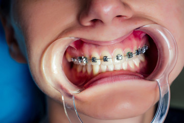 female dental open mouth with fixator gel braces at the reception.Bracket System kappa close up