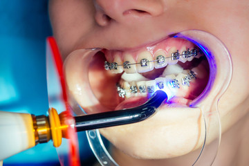 female dental open mouth with fixator gel braces at the reception.Bracket System kappa close up