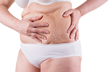 Female belly with stretch marks isolated on white background