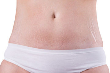 Fototapeta na wymiar Female belly with stretch marks isolated on white background