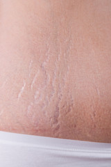 Female belly with stretch marks closeup