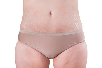 Female belly with stretch marks isolated on white background