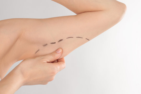 Woman with marks on arm for cosmetic surgery operation against grey background, closeup