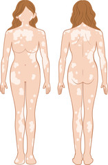 Fototapeta premium 白斑 全身 女性