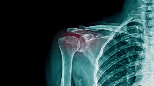 shoulder pain x-ray footage with red hight light on shoulder joint, clavicle fracture with pain around shoulder joint