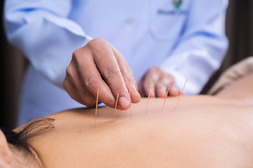 woman undergoing acupuncture treatment on back - obrazy, fototapety, plakaty