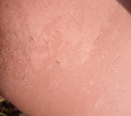 Fototapeta premium Exfoliation of the skin after sunburn. Excessive tan.
