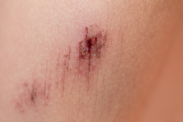 Closeup injured at leg, Fresh wounds from accident. 