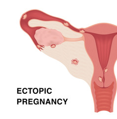 Ectopic pregnancy. Vector realistic medical illustration with inscriptions. Female reproductive organs. Frontal view in a cut.
