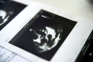 Heart ultrasound image print on paper