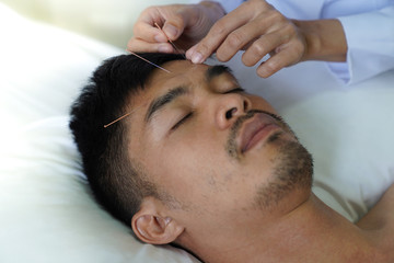 Fototapeta na wymiar Closeup of hand performing acupuncture therapy young Asian man's face
