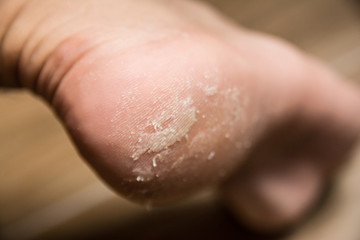 heel disease close up