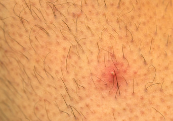 Caucasion skin acne spot