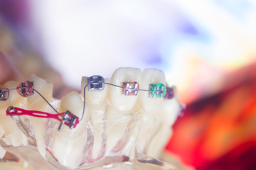 Dental brackets teeth straighteners