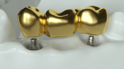 Implants with golden dental bridge - 3d rendering
