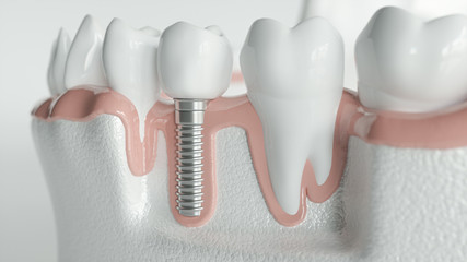 Healthy teeth and an implant - 3d rendering - obrazy, fototapety, plakaty