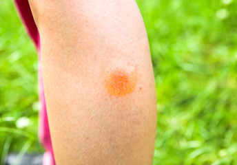Mosquito bite on the leg. Insects in the summer. Dangerous nature. Itchy body.