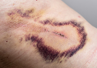 Large painful hematoma