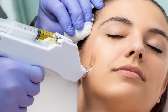 Facial mesotherapy with micro needling.