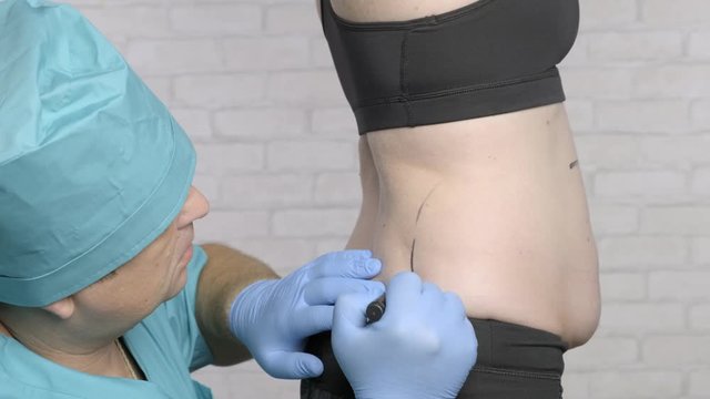 plastic surgeon draws markings on a woman's body before liposuction.
