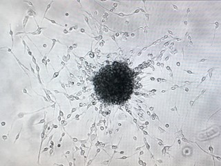 Сancer cells  under the microscope