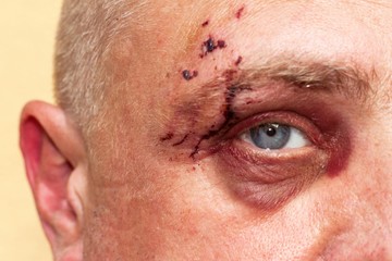 Naklejka premium Male eye with a large purple bruise. Biting dog on face. Eye injury. Large bruising on the male eye. Treatment of injuries. Boxer eye.