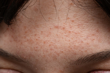Problems with skin acne and pore on woman's forehead