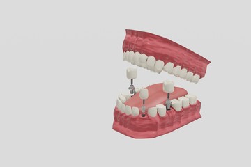 Dental Implants Treatment Procedure. Medically accurate 3D illustration dentures concept.