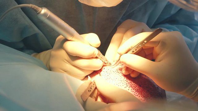 Patient's head close-up. Baldness treatment. Hair transplant. Surgeons in the operating room carry out hair transplant surgery. Surgical technique that moves hair follicles from a part of the head.