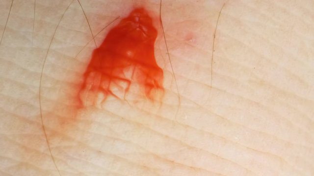 Wound and bleeding at leech bite. Close-up 