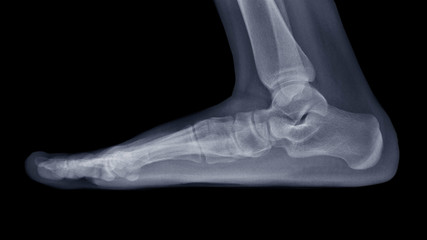 Film X-ray foot radiograph show Flat foot deformity (pes planus or fallen arches) and abnormal...