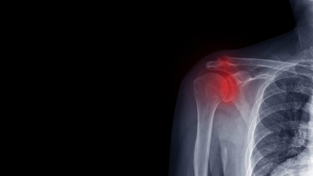 Film X ray shoulder radiograph show degenerative osteoarthritis disease of glenohumeral and acromioclavicular joint (OA shoulder disorder). Red highlight on stiffness and painful area. Medical concept