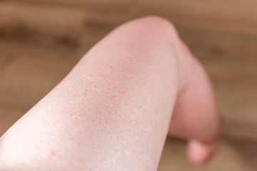 After shaving legs irritation with razor.