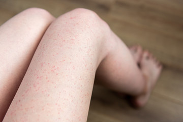 After shaving legs irritation with razor.