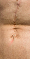 Fototapeta premium Keloid scar on man's stomach