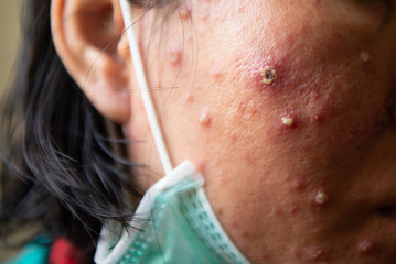 Pustules caused by viral infections or chickenpox disease - obrazy, fototapety, plakaty