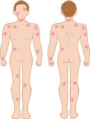 ひっかき傷　全身　男性