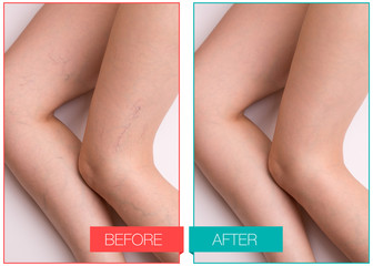 Varicose veins on the legs of a woman. Legs of a girl with varicose veins before and after.