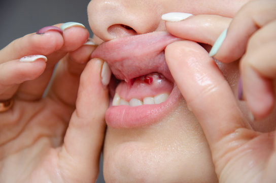 Close-up of gum with cyst or purulent flux. Disease of the gums and teeth.