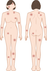 Fototapeta premium 化膿 全身 女性