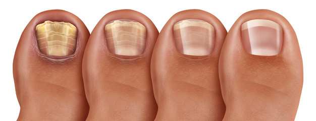 Fungal Nail Infection Recovery - obrazy, fototapety, plakaty