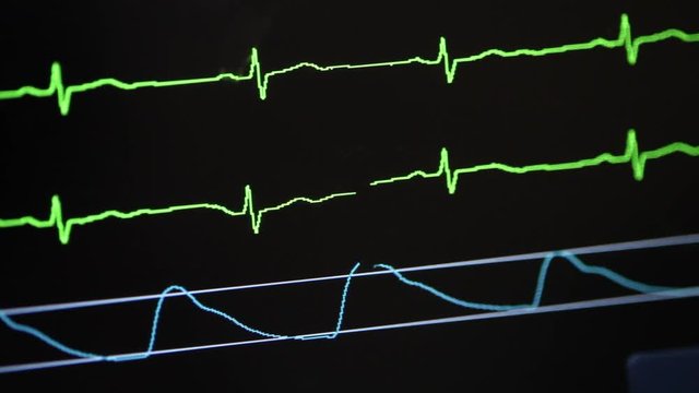 ECG Monitor in ICU in Hospital